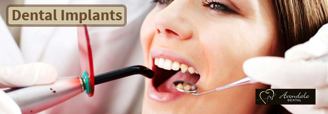 dental implants brampton