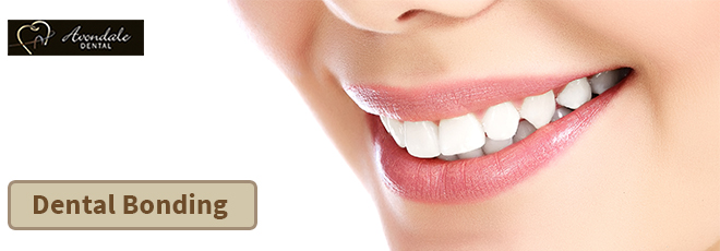 Dental Bonding Brampton